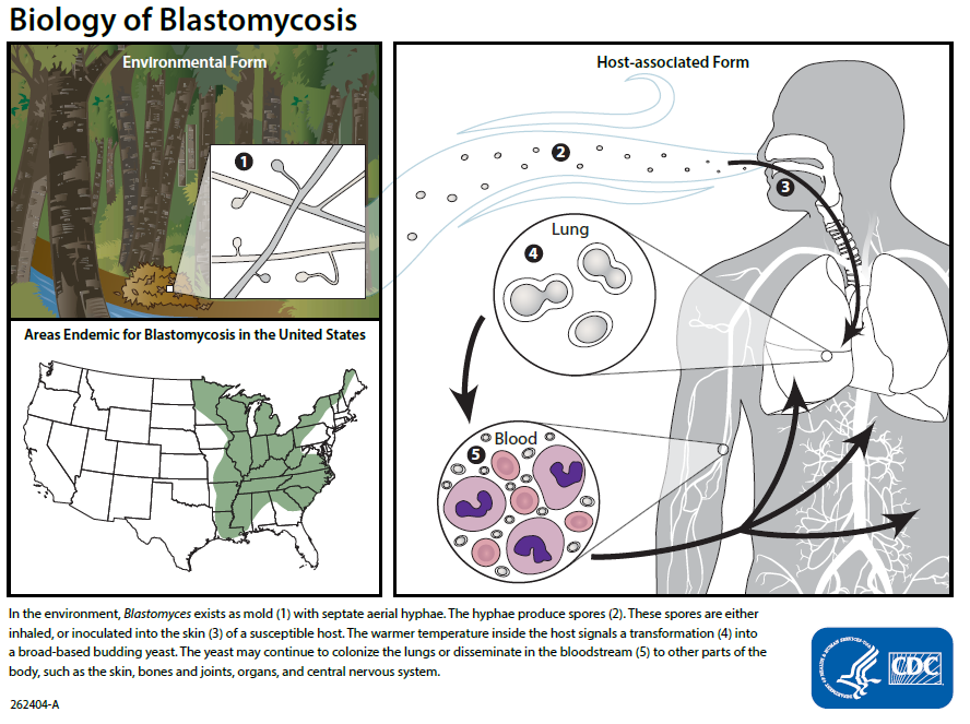 Blastomycosis essay picture