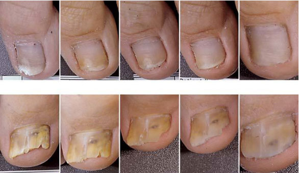 Onychomycosis