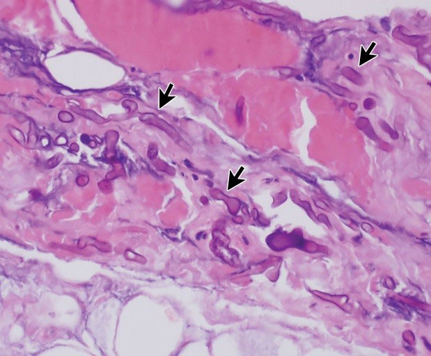 Ribbonlike Mucor hyphae 7 15 wide at histologic examination