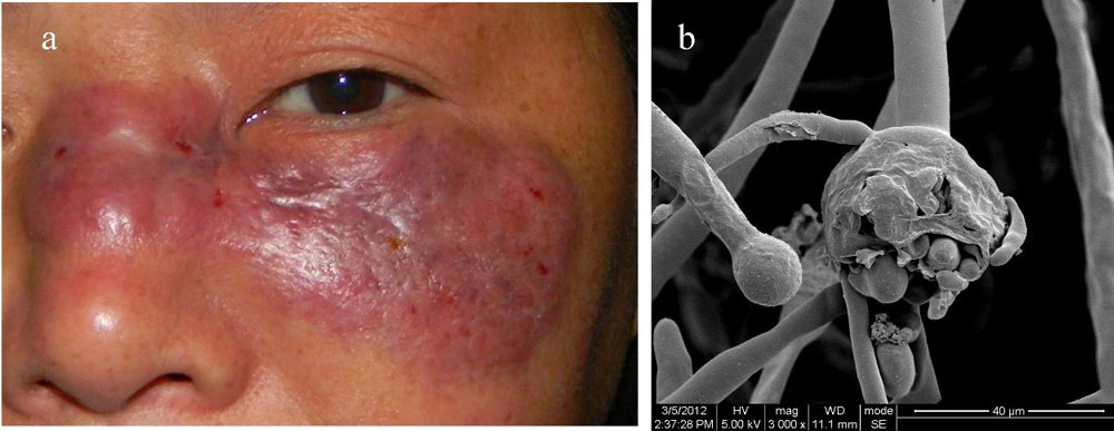 cutaneous mucormycosis caused by Mucor irregularis