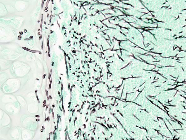 figure 1. pulmonary invasive aspergillosis in a pneumonia patient