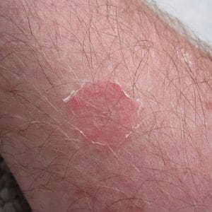 Ringworm lesion on the forearm of 45 year old Caucasian male caused by Microsporum gypseum