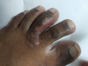 Athlete’s foot (tinea pedis)