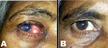 (A) Patient with the traumatic corneal ulcer caused by N. sphaerica and, (B) the patient during follow up eight months after topical and oral voriconazole therapy