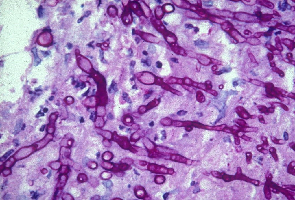 Scedosporium apiospermum in the infected eye tissue